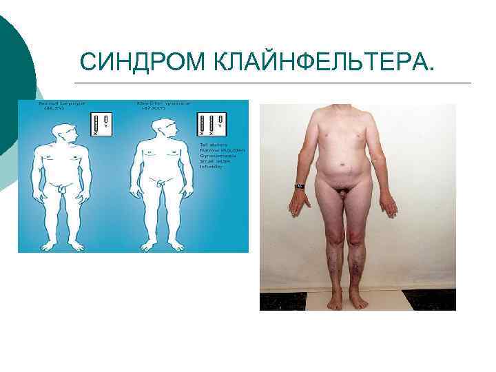 СИНДРОМ КЛАЙНФЕЛЬТЕРА. 