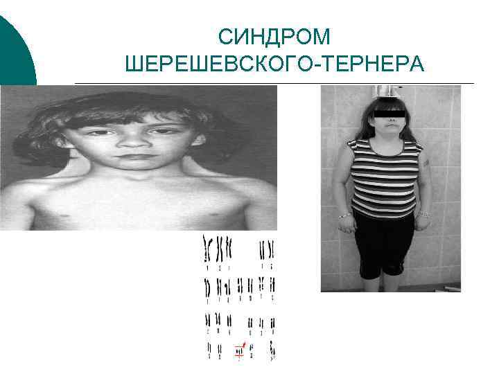  СИНДРОМ ШЕРЕШЕВСКОГО-ТЕРНЕРА 