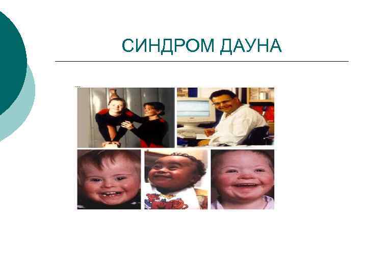СИНДРОМ ДАУНА 