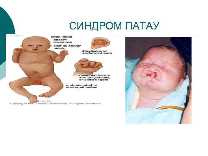 СИНДРОМ ПАТАУ 