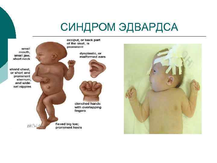 СИНДРОМ ЭДВАРДСА 