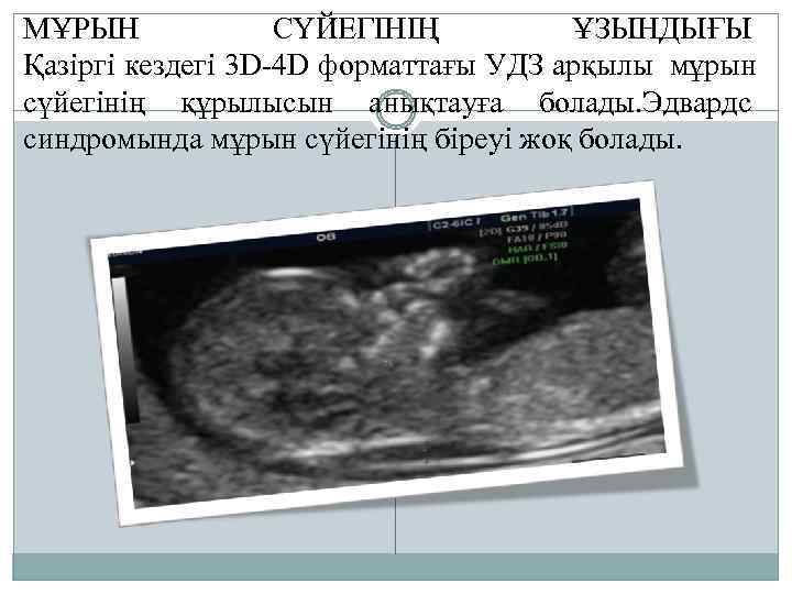 МҰРЫН   СҮЙЕГІНІҢ   ҰЗЫНДЫҒЫ Қазіргі кездегі 3 D-4 D форматтағы УДЗ