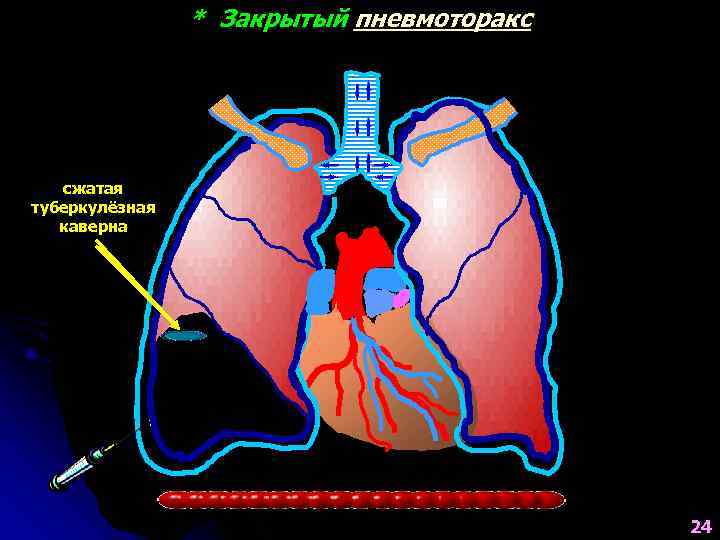    * Закрытый пневмоторакс  сжатая  туберкулёзная каверна, которую 