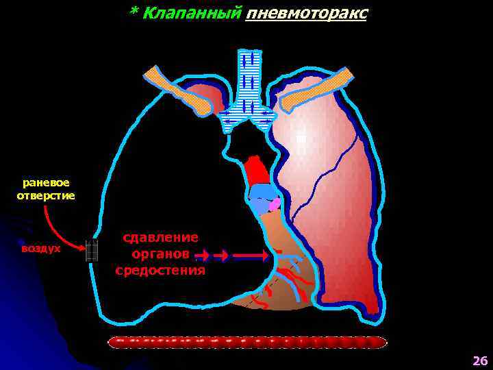    * Клапанный пневмоторакс раневое отверстие    сдавление воздух 