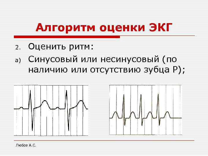   Алгоритм оценки ЭКГ 2.  Оценить ритм: a)  Синусовый или