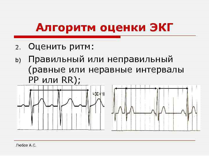    Алгоритм оценки ЭКГ 2.  Оценить ритм: b)  Правильный или