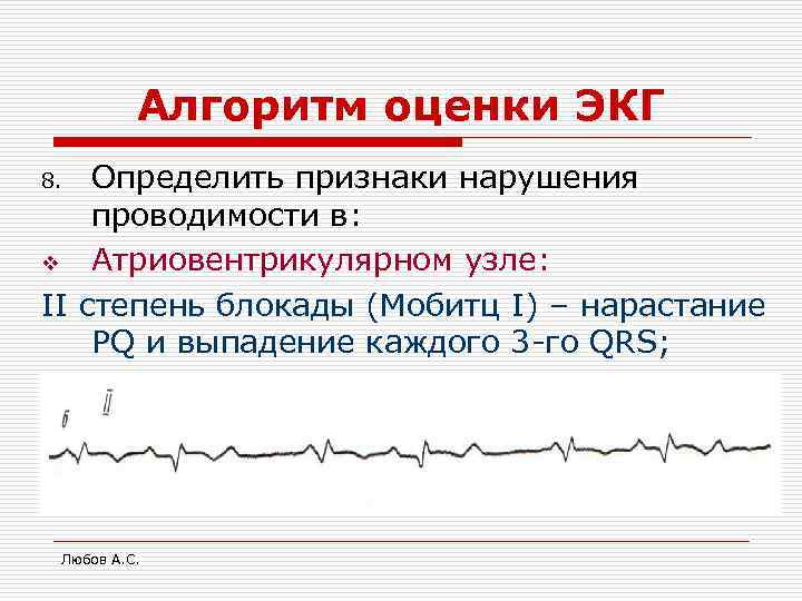    Алгоритм оценки ЭКГ 8.  Определить признаки нарушения проводимости в: v