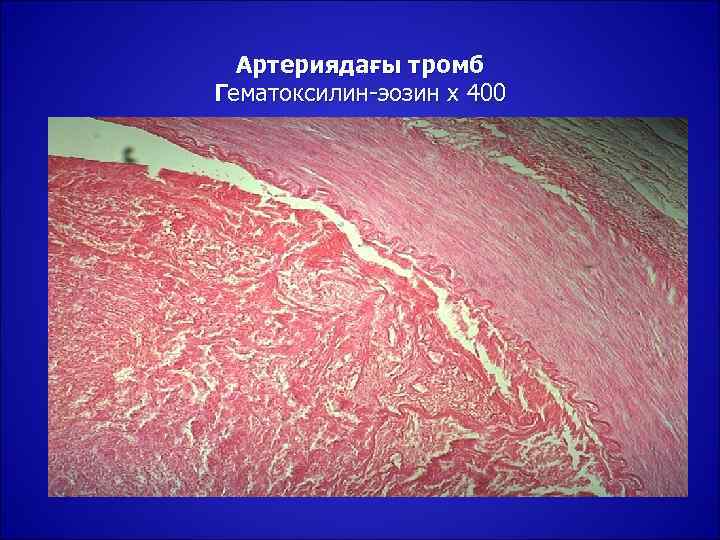  Артериядағы тромб Гематоксилин-эозин х 400 