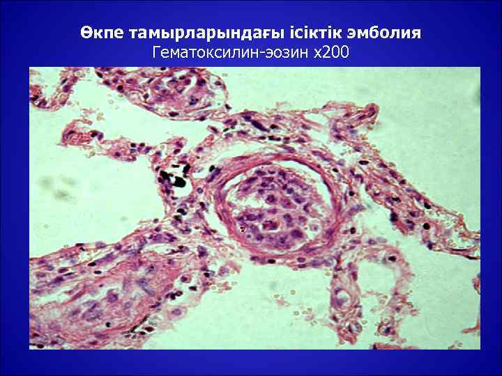 Өкпе тамырларындағы ісіктік эмболия  Гематоксилин-эозин х200 
