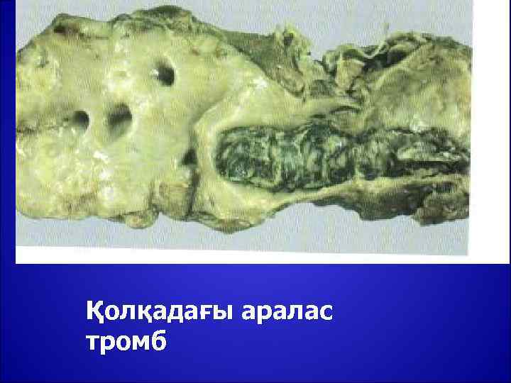 Қолқадағы аралас тромб 