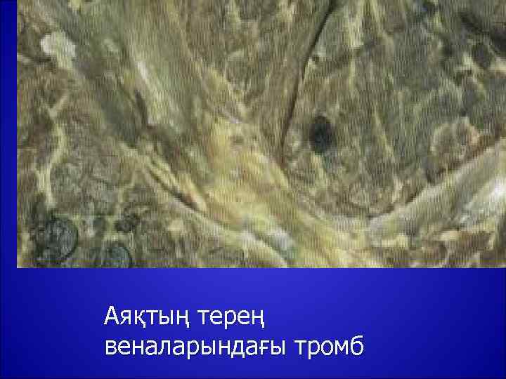 Аяқтың терең веналарындағы тромб 