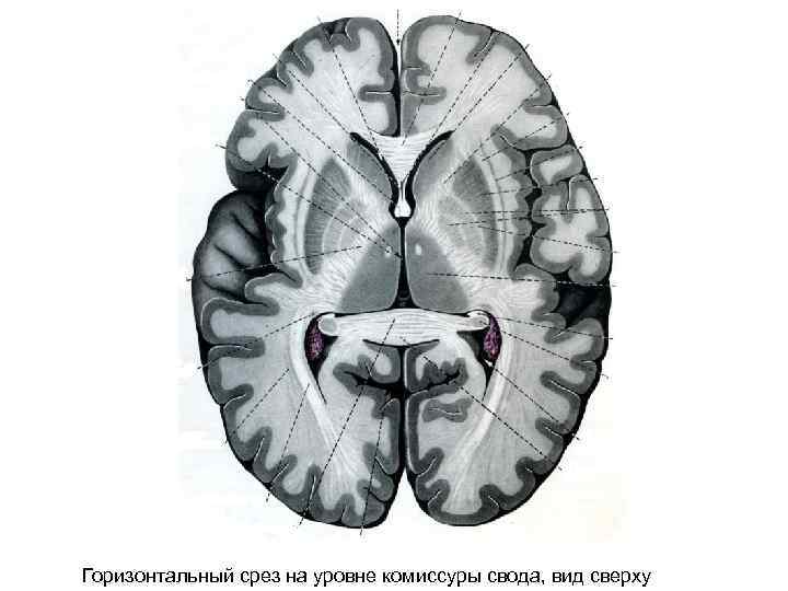 Горизонтальный срез на уровне комиссуры свода, вид сверху 