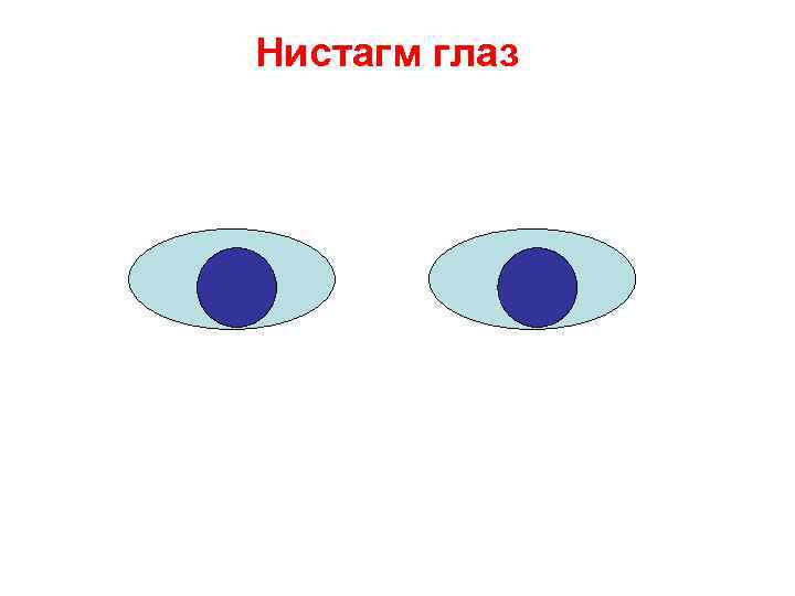 Нистагм глаз Нистагм глаз