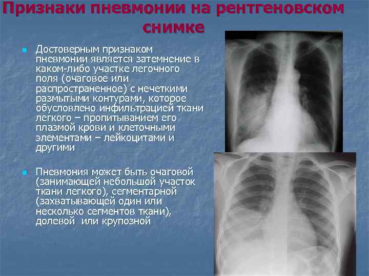 Признаки пневмонии на рентгеновском    снимке  n  Достоверным признаком 