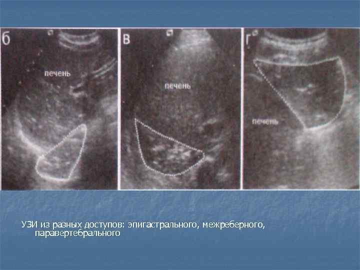 УЗИ из разных доступов: эпигастрального, межреберного, паравертебрального 