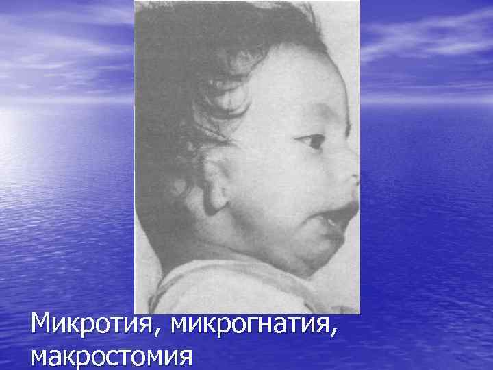 Микротия, микрогнатия, макростомия 