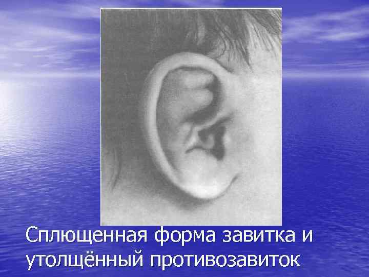 Сплющенная форма завитка и утолщённый противозавиток 