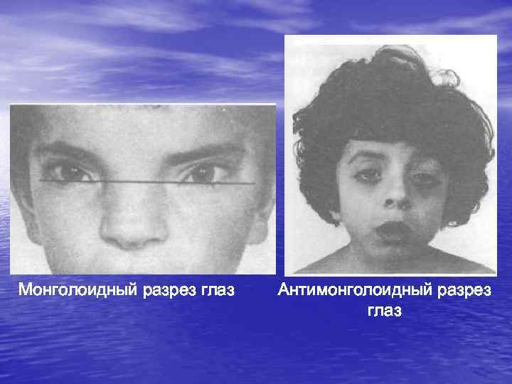 Монголоидный разрез глаз  Антимонголоидный разрез       глаз 