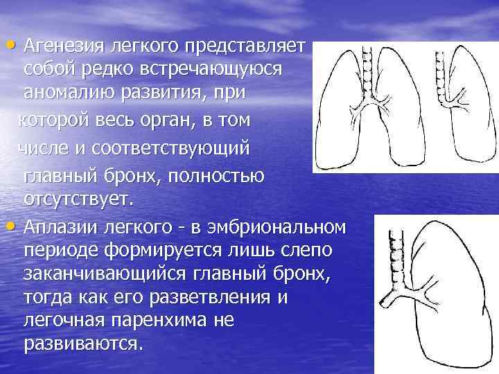  • Агенезия легкого представляет  собой редко встречающуюся  аномалию развития, при которой