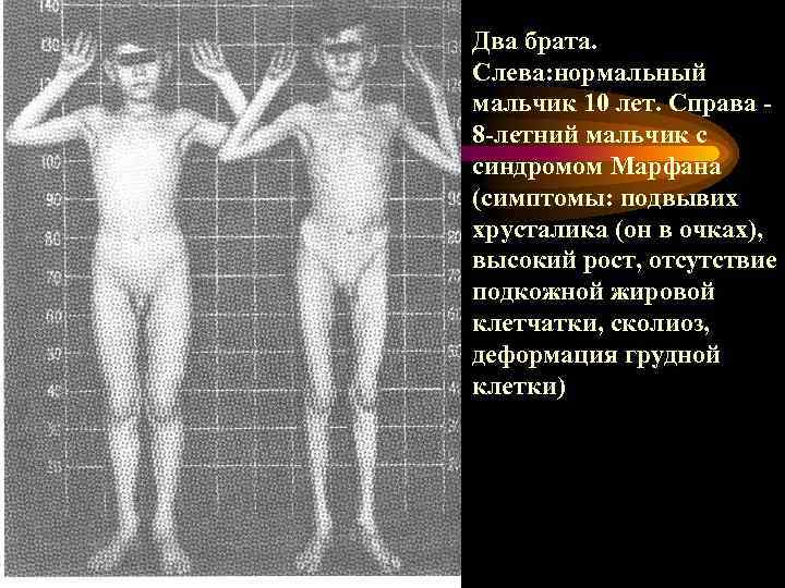 Два брата. Слева: нормальный мальчик 10 лет. Справа 8 -летний мальчик с синдромом Марфана