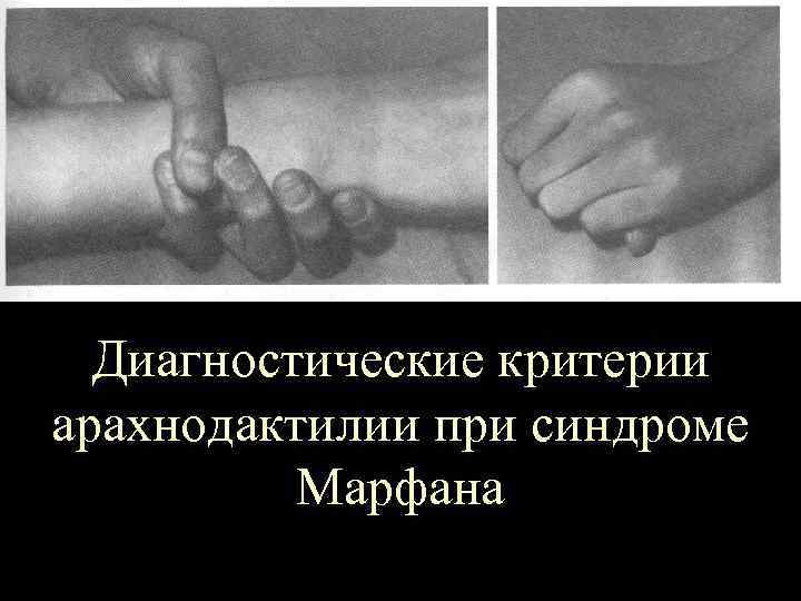 Диагностические критерии арахнодактилии при синдроме Марфана 