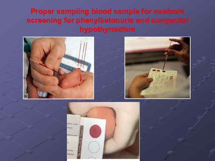  Proper sampling blood sample for newborn screening for phenylketonuria and congenital  