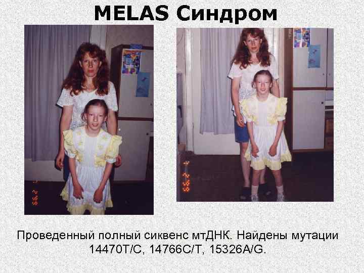   MELAS Синдром Проведенный полный сиквенс мт. ДНК. Найдены мутации  14470 T/C,