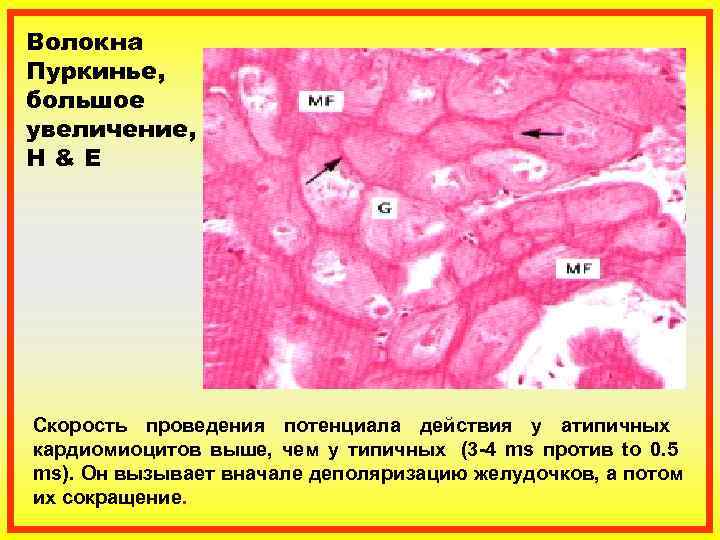 Волокна Пуркинье, большое увеличение, H&E Скорость проведения потенциала действия у атипичных  кардиомиоцитов выше,