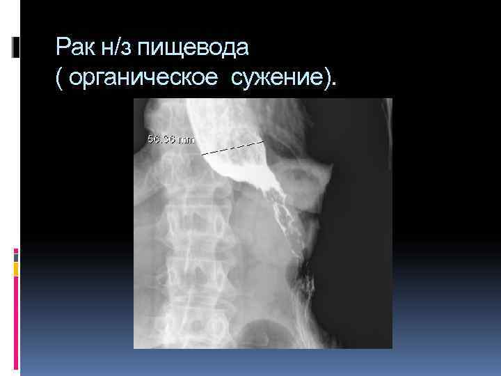 Рак н/з пищевода ( органическое сужение). Рак н/з пищевода ( органическое сужение).