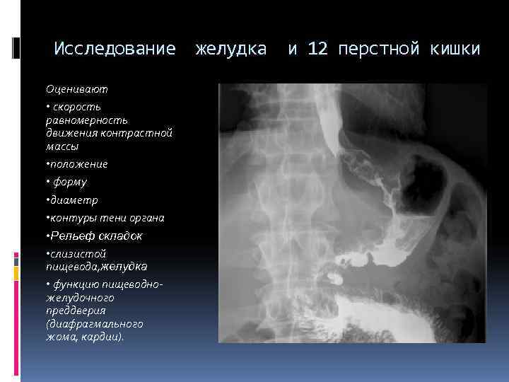 Исследование желудка. Рентгенологическое исследование 12-перстной кишки. Рентгенологическое исследование желудка и 12-перстной кишки. Рентген 12 перстной кишки. Рентген исследования желудка и 12 перстной кишки.