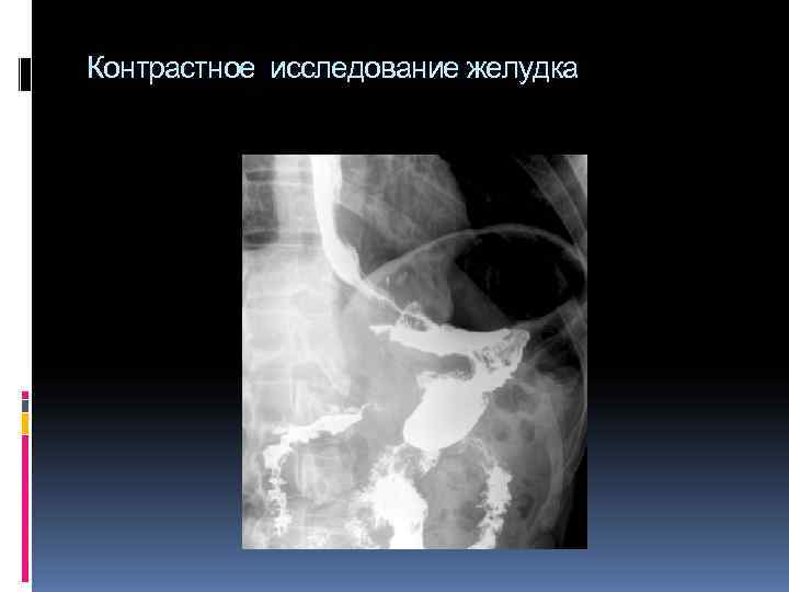 Контрастное исследование желудка Контрастное исследование желудка