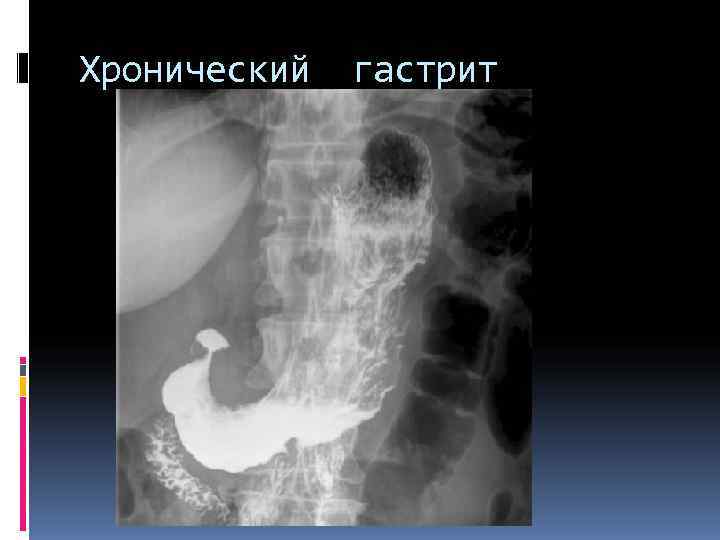Хронический гастрит . Хронический гастрит .