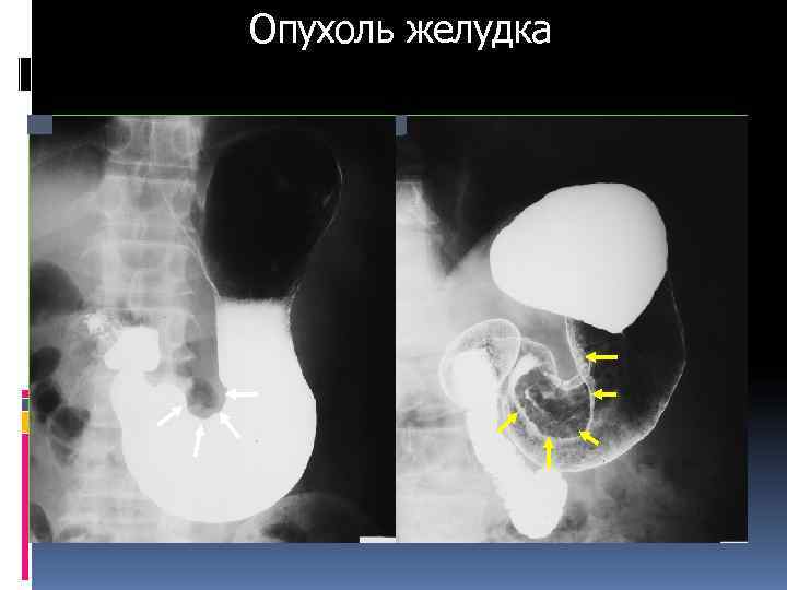 Опухоль желудка Опухоль желудка