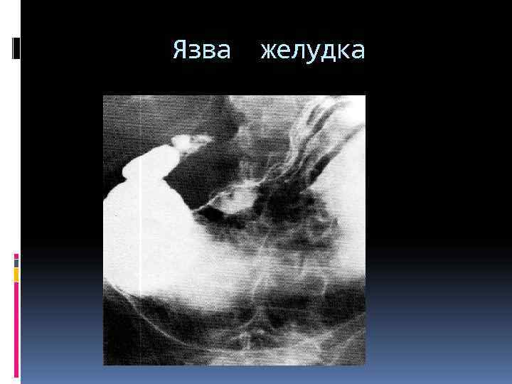 Язва желудка Язва желудка