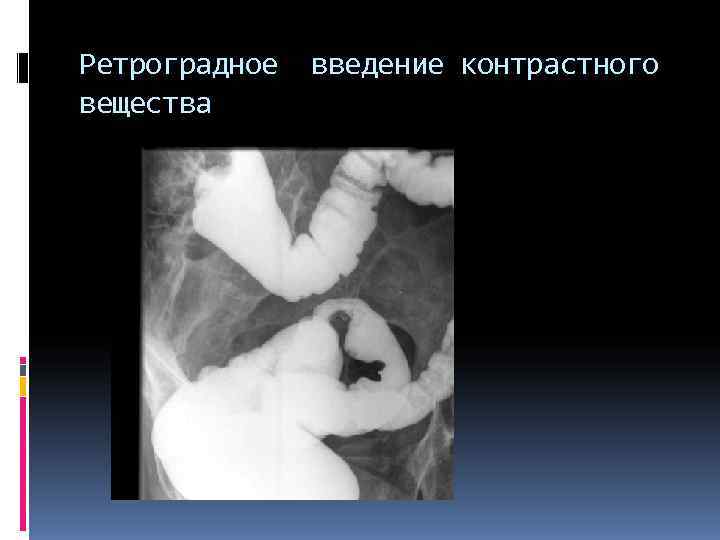 Ретроградное введение контрастного вещества Ретроградное введение контрастного вещества