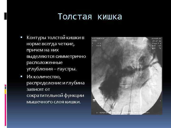 Толстая кишка Контуры толстой кишки в норме всегда четкие, Толстая кишка Контуры толстой кишки в норме всегда четкие,