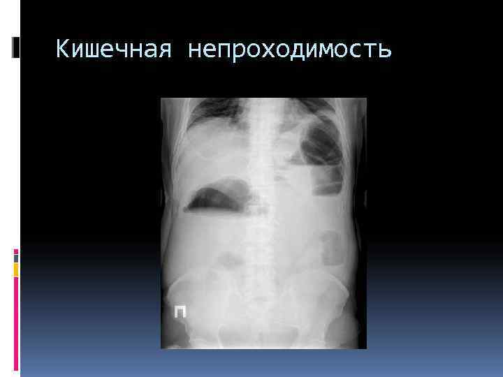 Кишечная непроходимость Кишечная непроходимость