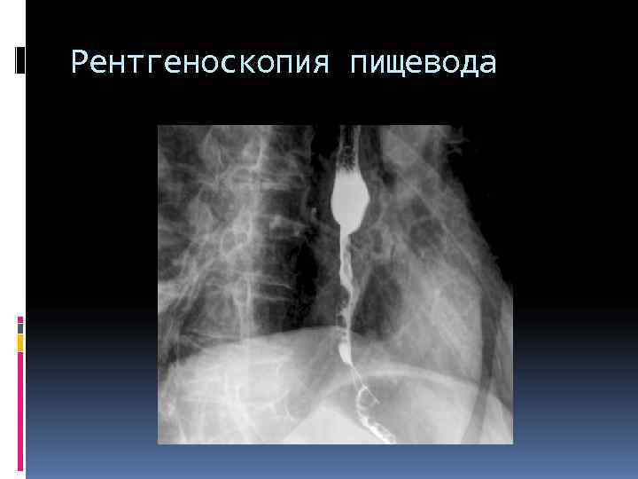 Рентгеноскопия пищевода Рентгеноскопия пищевода