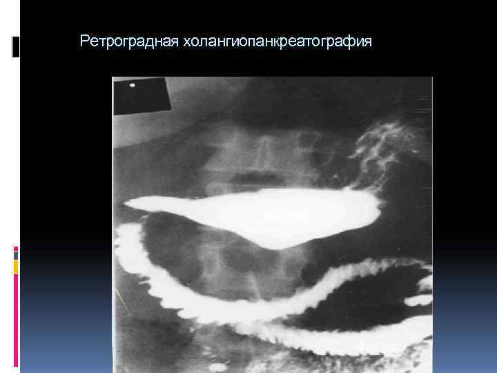 Ретроградная холангиопанкреатография Ретроградная холангиопанкреатография