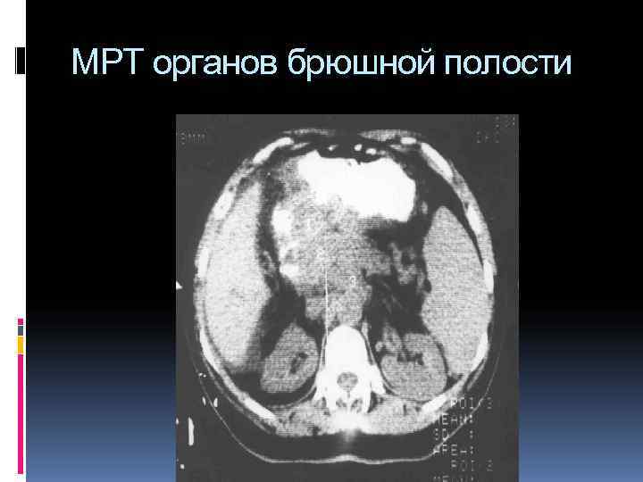 МРТ органов брюшной полости МРТ органов брюшной полости