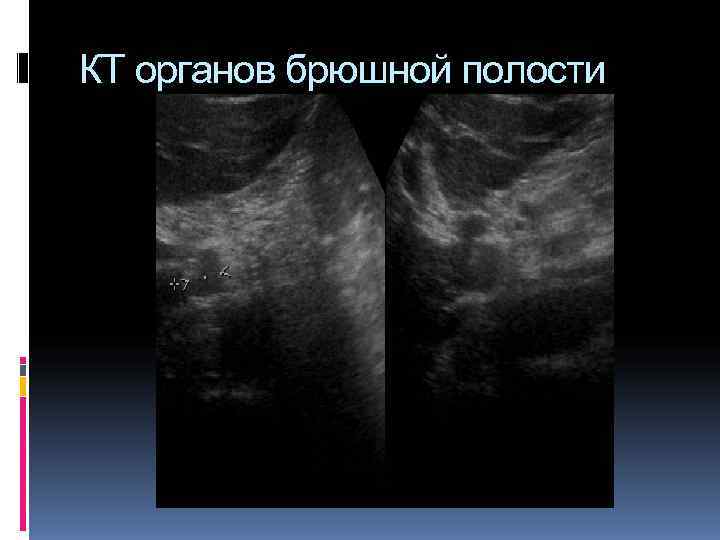 КТ органов брюшной полости КТ органов брюшной полости