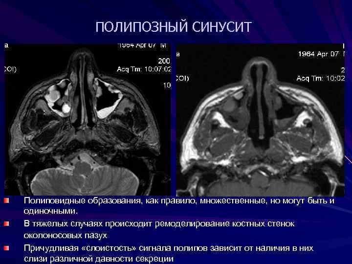 ПОЛИПОЗНЫЙ СИНУСИТ Полиповидные образования, как правило, множественные, но могут быть и одиночными. В тяжелых