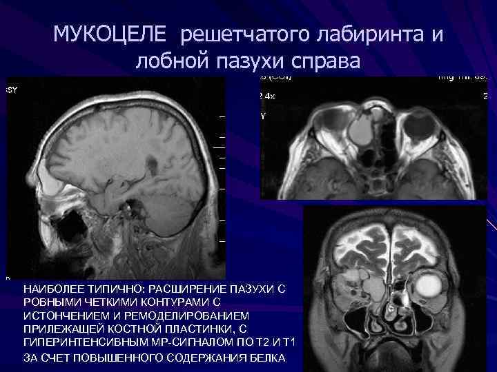 МУКОЦЕЛЕ решетчатого лабиринта и лобной пазухи справа • НАИБОЛЕЕ ТИПИЧНО: РАСШИРЕНИЕ ПАЗУХИ С РОВНЫМИ