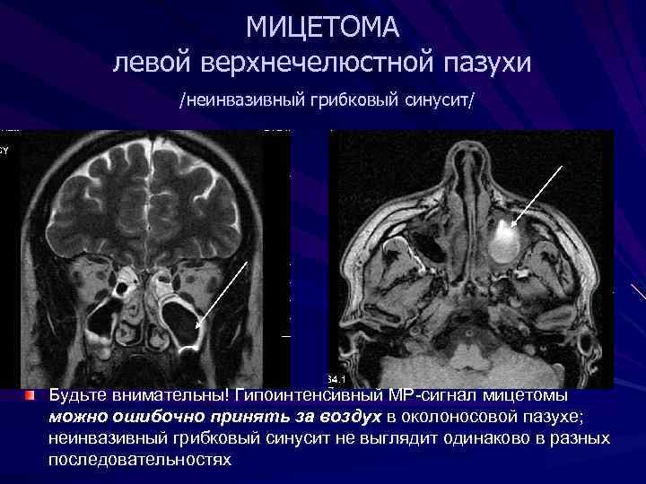 МИЦЕТОМА левой верхнечелюстной пазухи /неинвазивный грибковый синусит/ Будьте внимательны! Гипоинтенсивный МР-сигнал мицетомы можно ошибочно