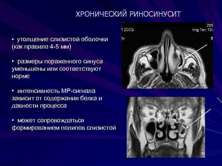 ХРОНИЧЕСКИЙ РИНОСИНУСИТ • утолщение слизистой оболочки (как правило 4 -5 мм) • размеры пораженного