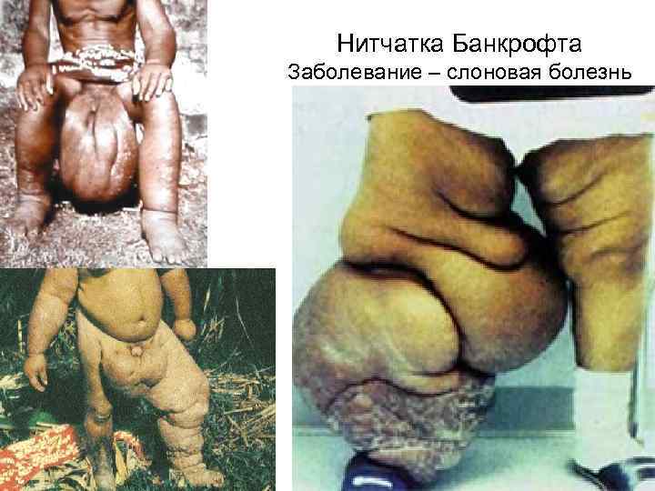 Нитчатка Банкрофта Заболевание – слоновая болезнь 