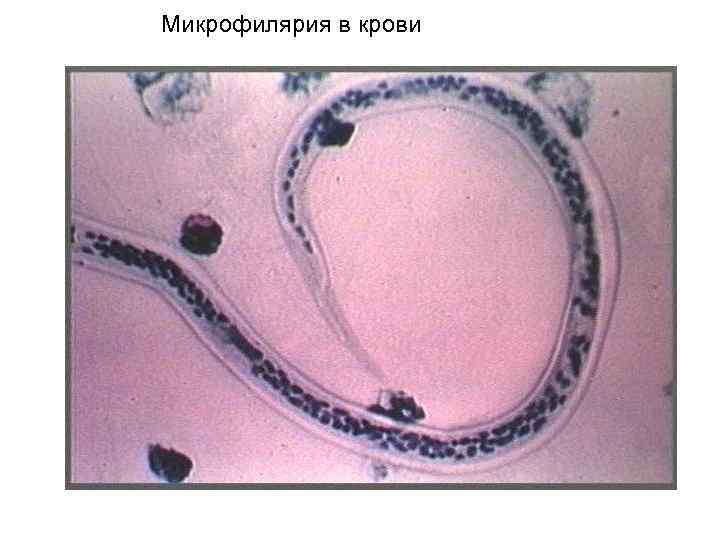 Микрофилярия в крови 