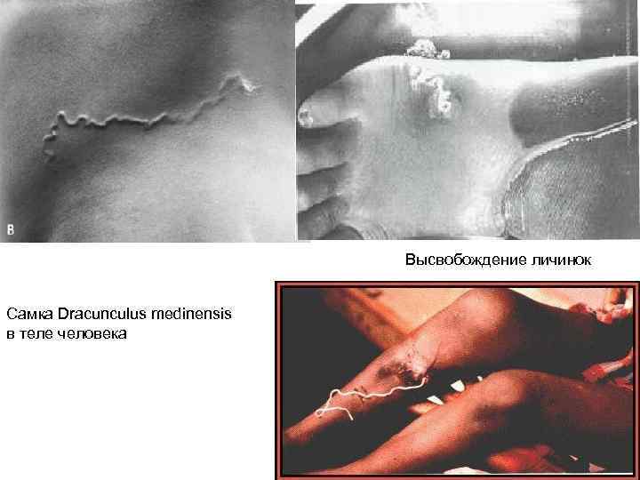 Высвобождение личинок Самка Dracunculus medinensis в теле человека 