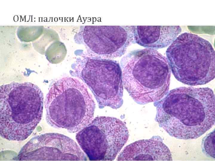 ОМЛ: палочки Ауэра 