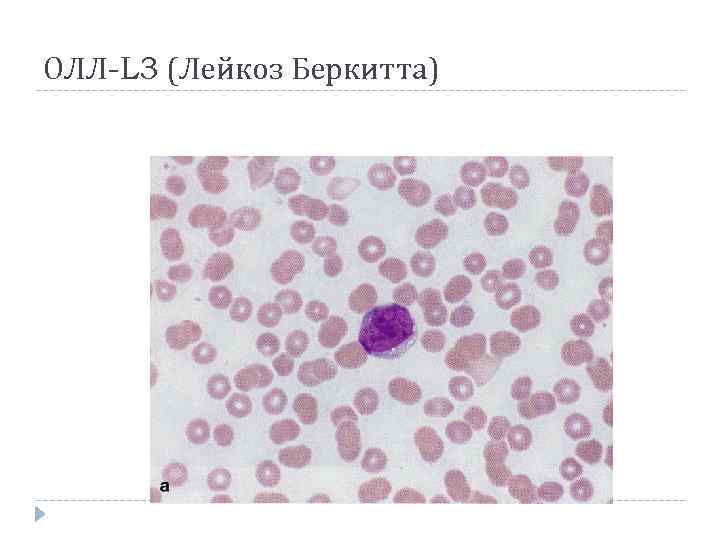 ОЛЛ-L 3 (Лейкоз Беркитта) 